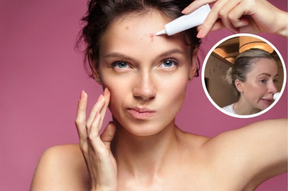 Najhoršia vec, ktorú môžete v lete urobiť. Dermatológ o tom nepochybuje. Akné a čierne bodky zaručené