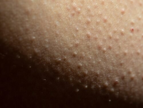 Máte už dosť „husej kože“? Vezmite si vrecúško a zmiešajte ho s vodou. 5 minút a je po probléme